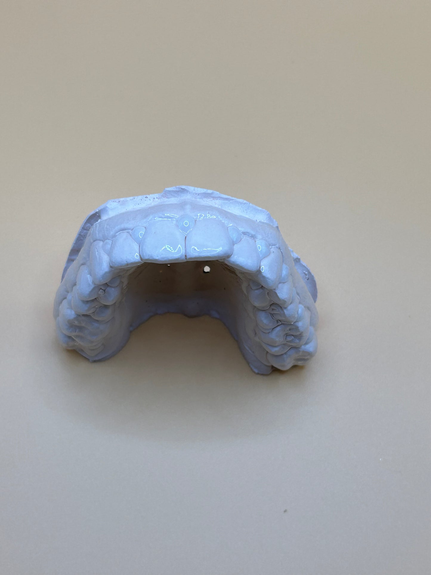 Cubetas personalizadas y Perio Restore® Gel: una gran solución para mantener la enfermedad periodontal bajo control